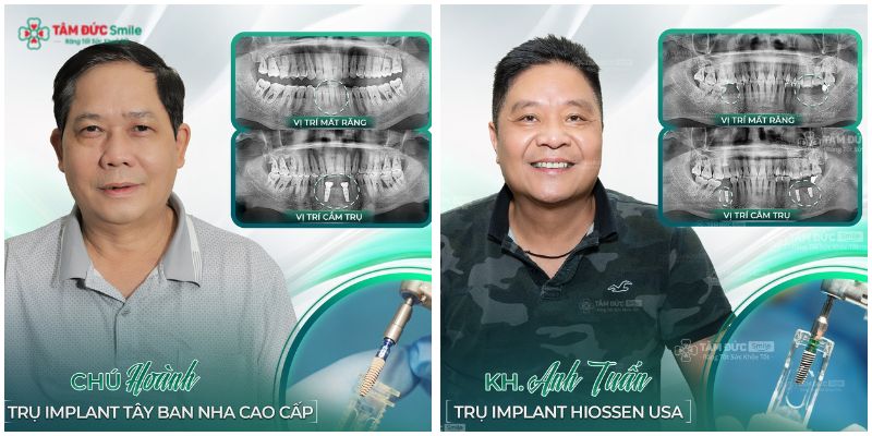 cay-ghep-implant-hai-chau-3