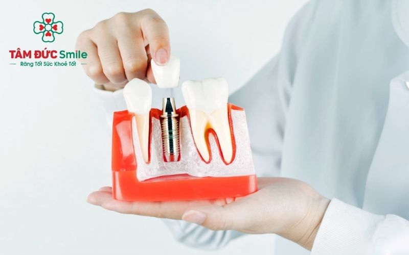cay-ghep-implant-hai-chau-6