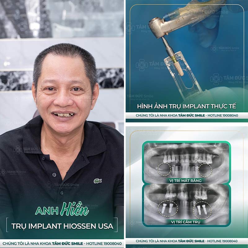 cấy ghép implant là gì