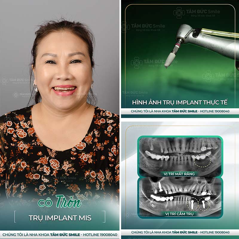 cấy ghép implant là gì