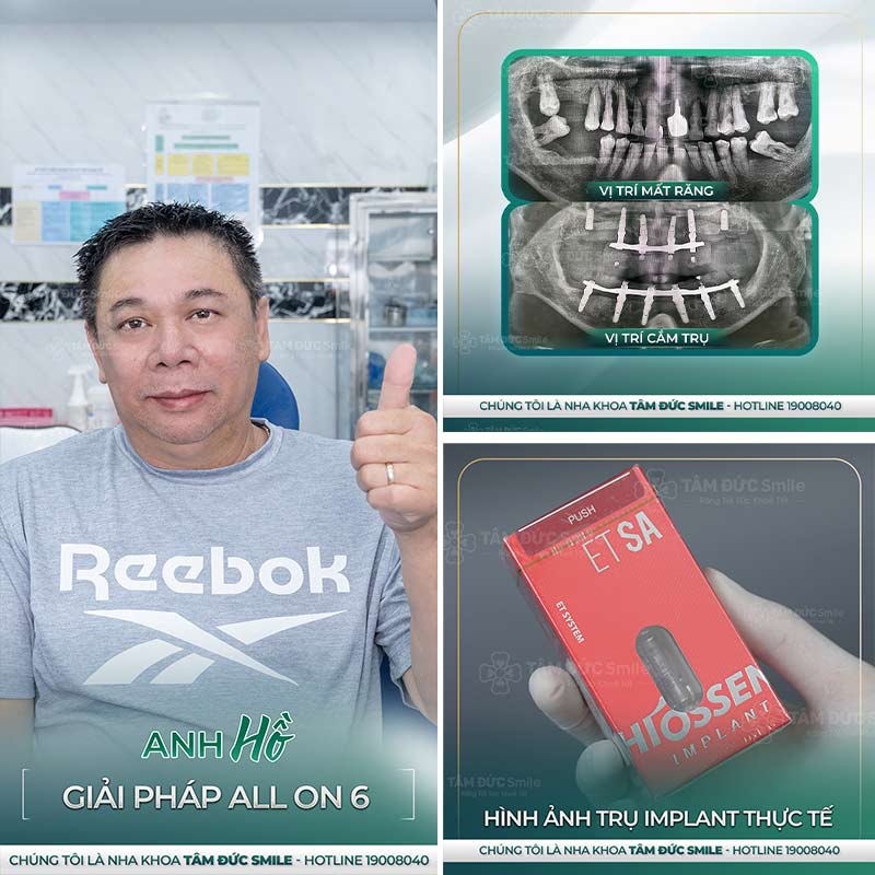 cấy ghép implant là gì