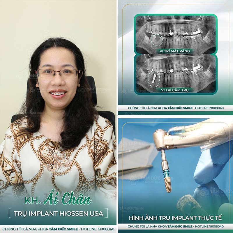 cấy ghép implant là gì