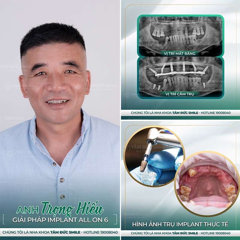 cấy ghép implant là gì