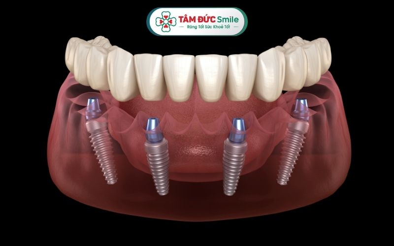 cay-ghep-implant-toan-ham-1
