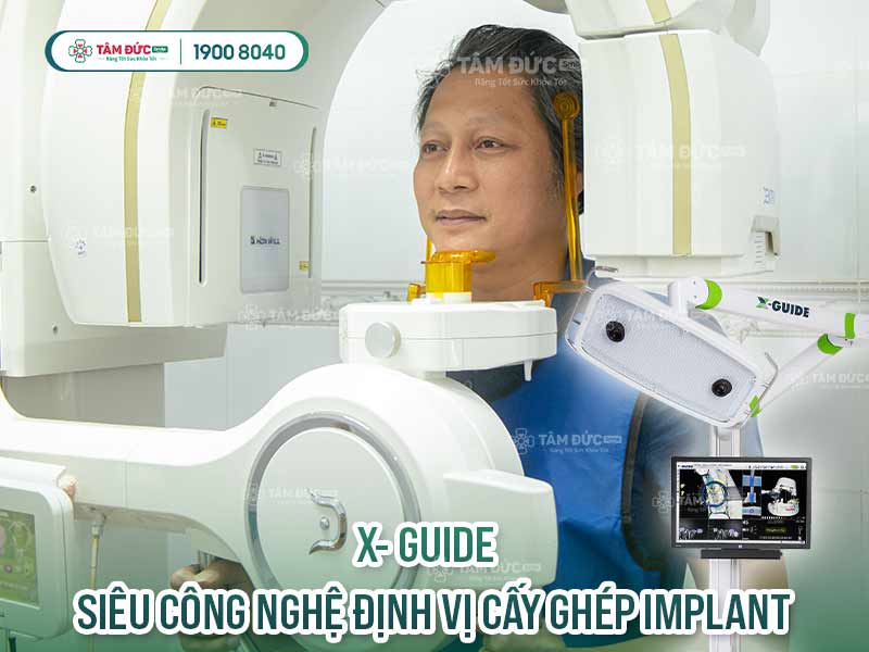 quy trình cấy ghép implant toàn hàm