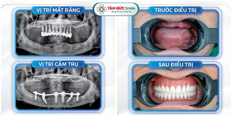 cay-ghep-implant-toan-ham-2