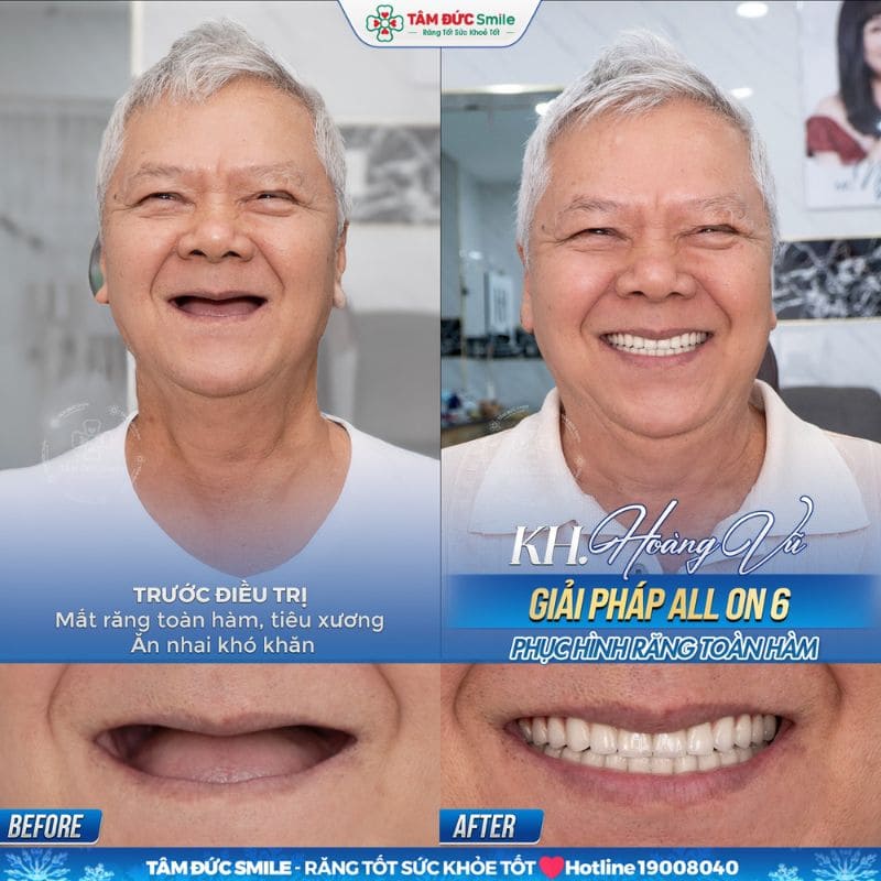 cay-ghep-implant-toan-ham-4