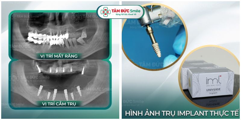 cay-ghep-implant-toan-ham-7
