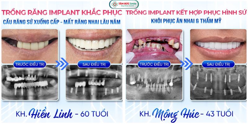 cay-ghep-implant-toan-ham-9