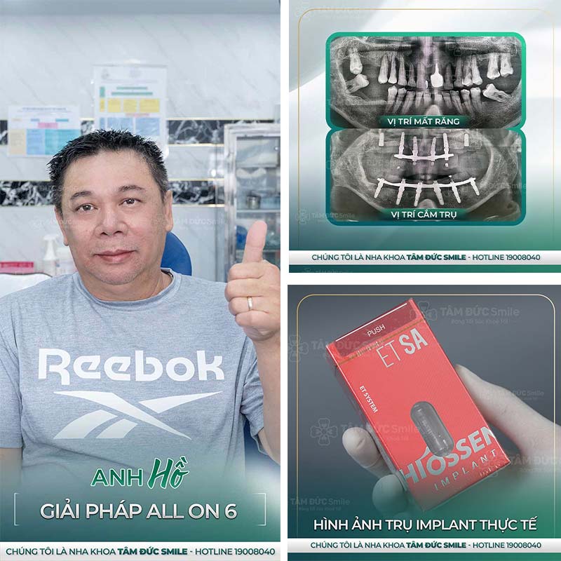 cấy ghép implant toàn hàm