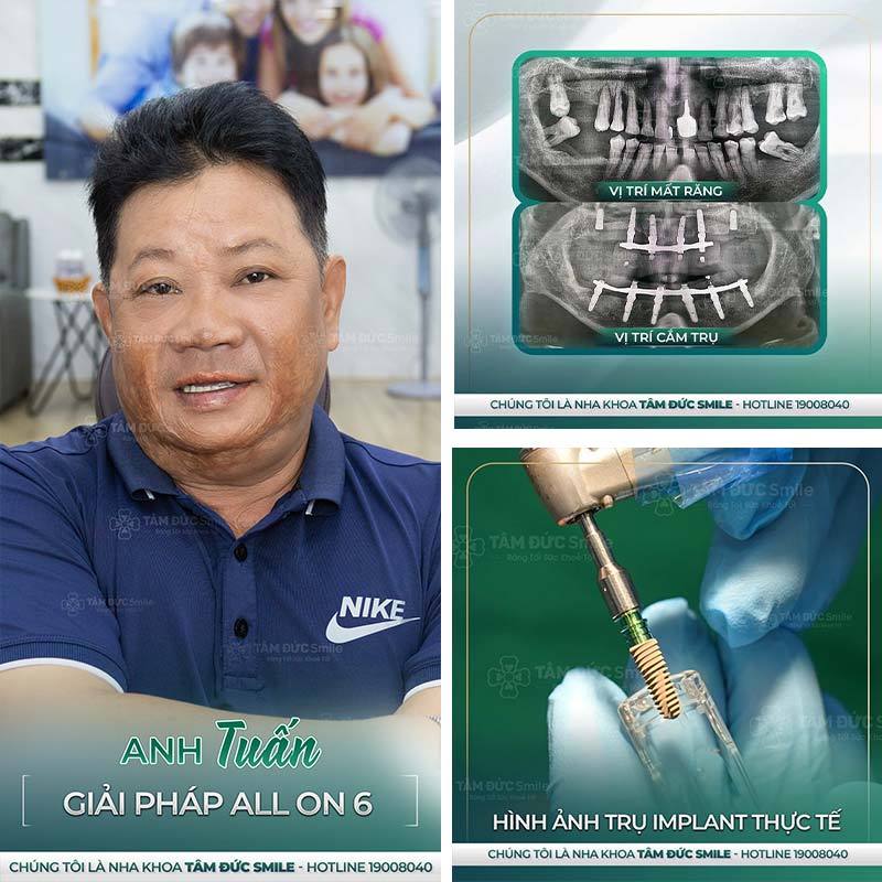 cấy ghép implant toàn hàm