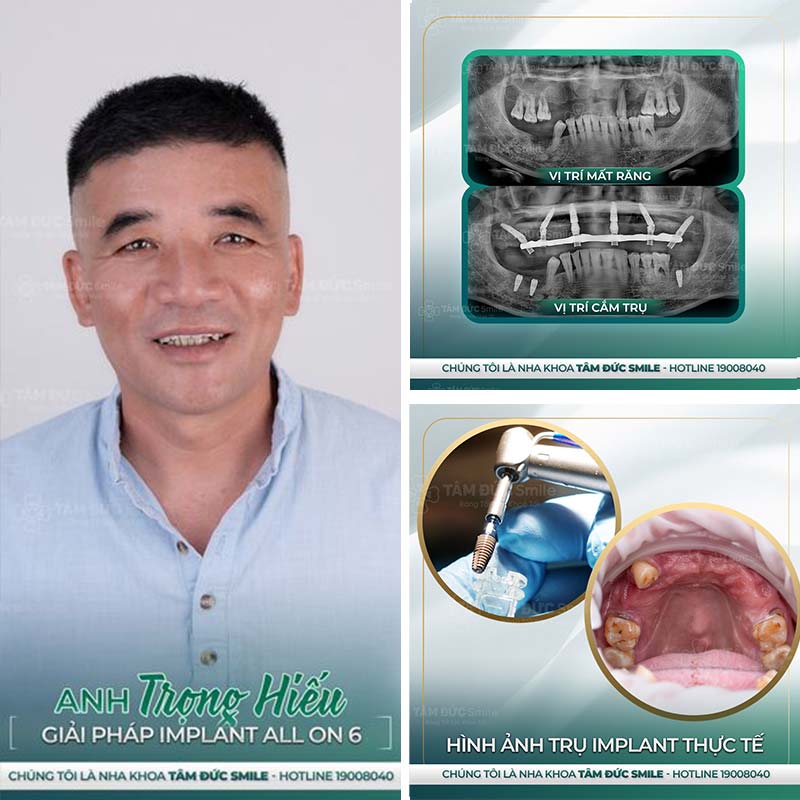 cấy ghép implant toàn hàm