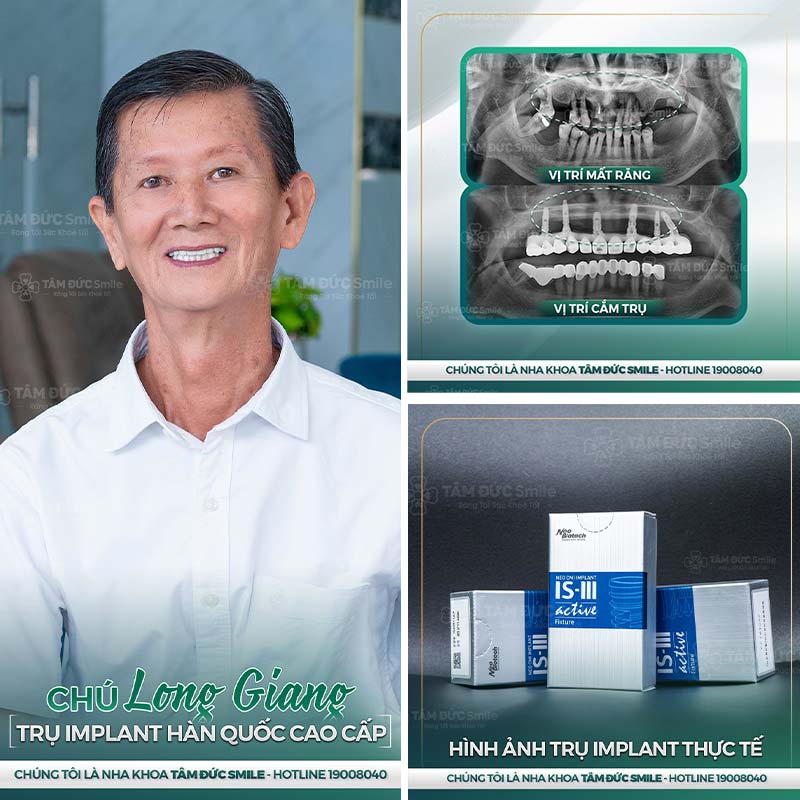 cấy ghép implant toàn hàm