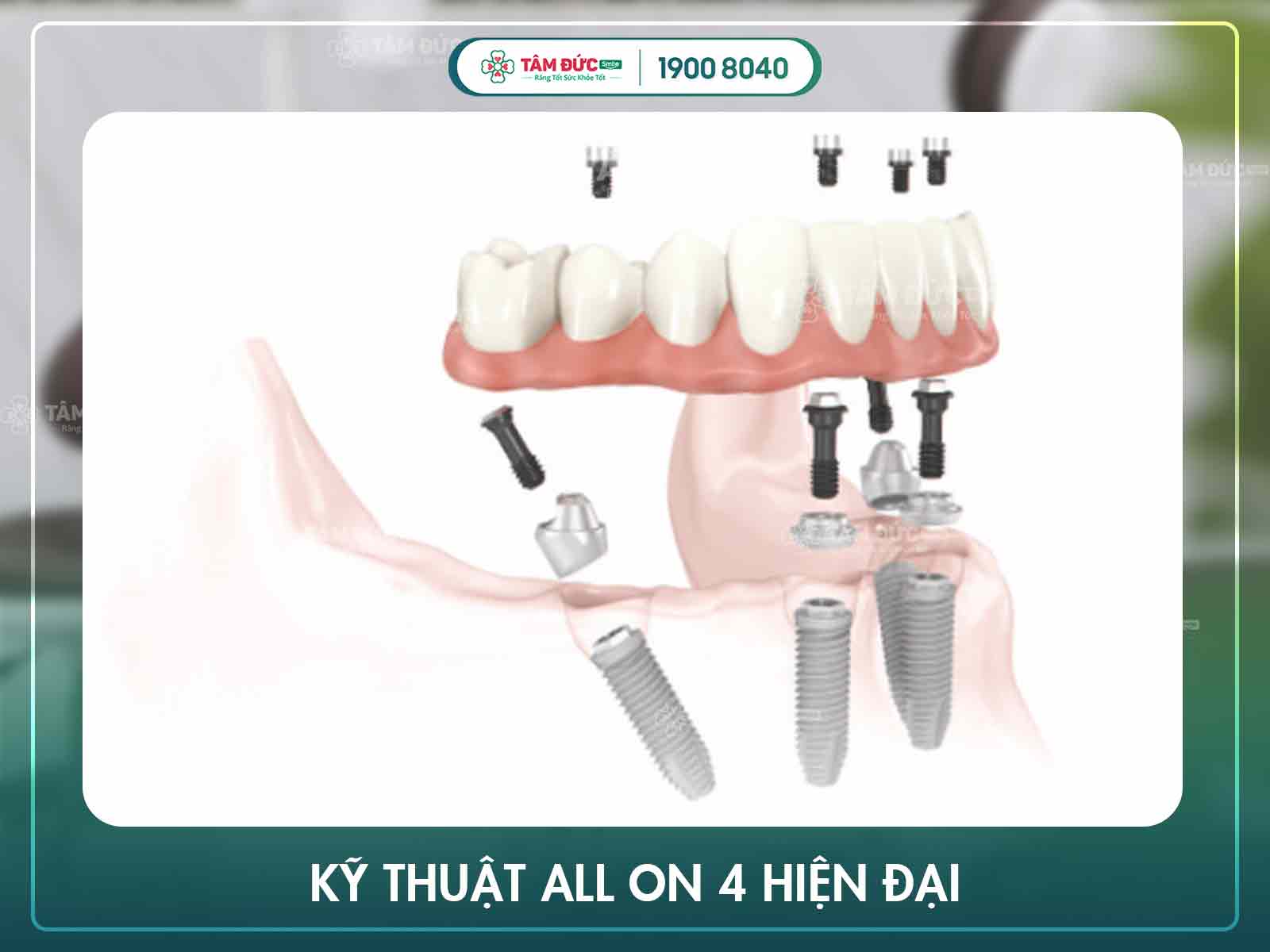 cấy ghép implant toàn hàm phương pháp all on 4