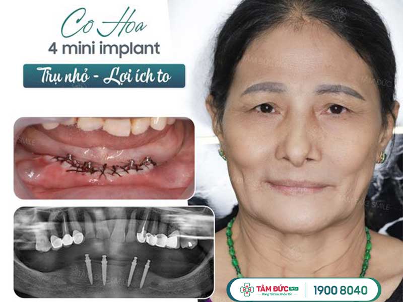 Cấy ghép mini implant giá bao nhiêu