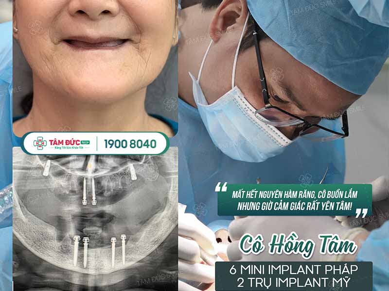 Cấy ghép mini implant giá bao nhiêu