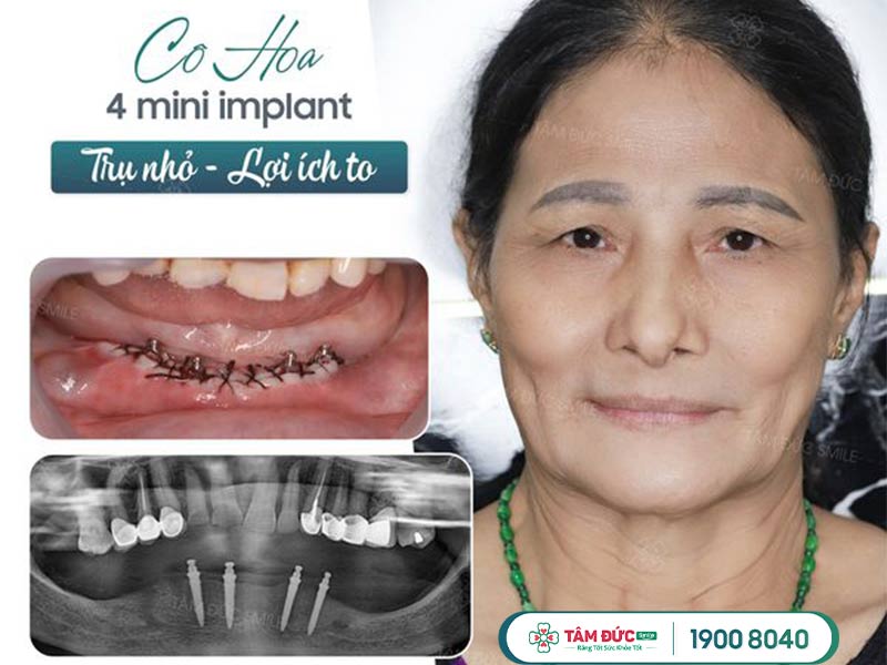 cấy ghép mini implant là gì