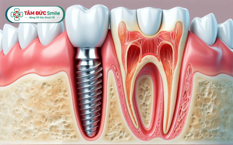 cay-ghep-rang-implant-1