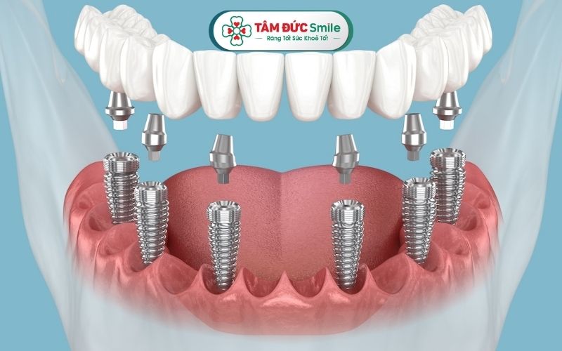 cay-ghep-rang-implant-2