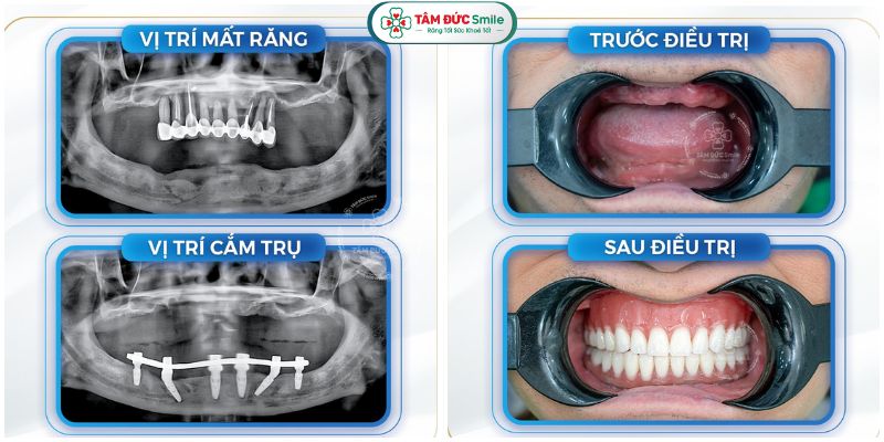 cay-ghep-rang-implant-3