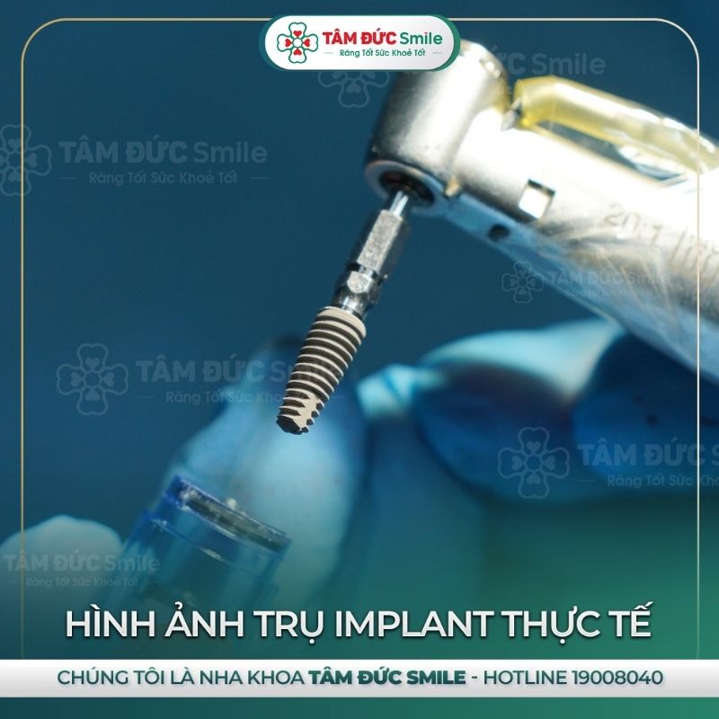 cay-ghep-rang-implant-4