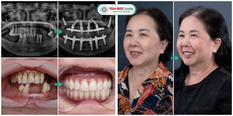 cay-ghep-rang-implant-5
