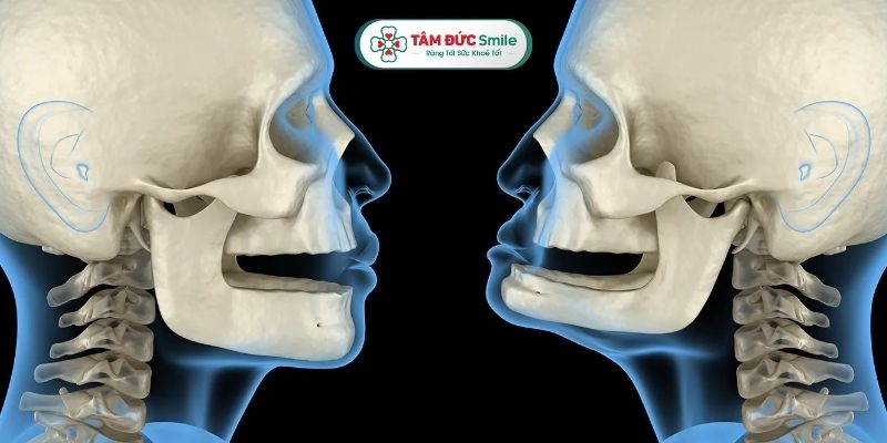 cay-ghep-rang-implant-6