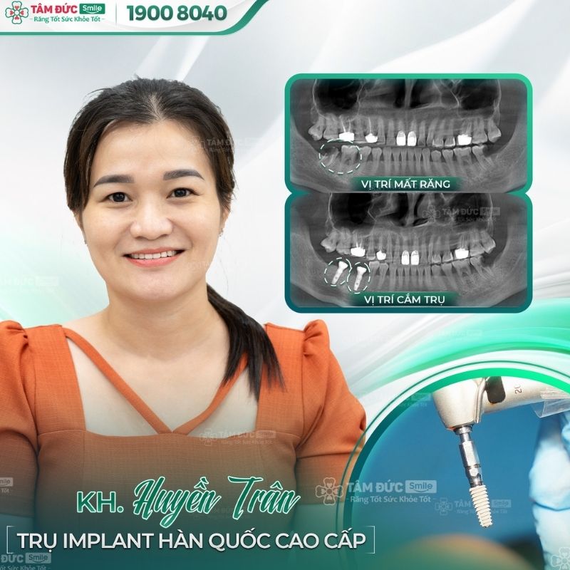 cay-ghep-rang-implant-8