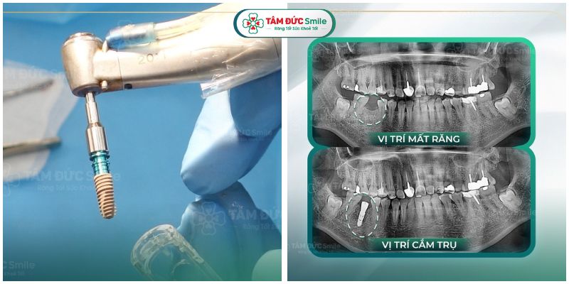cay-ghep-rang-implant-9