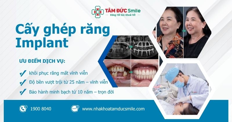 Cấy ghép răng Implant: Giải pháp trồng răng bền vững, bảo hành đến vĩnh viễn