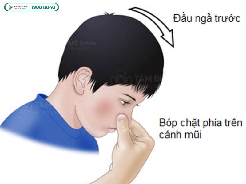 chảy máu cam là bị gì