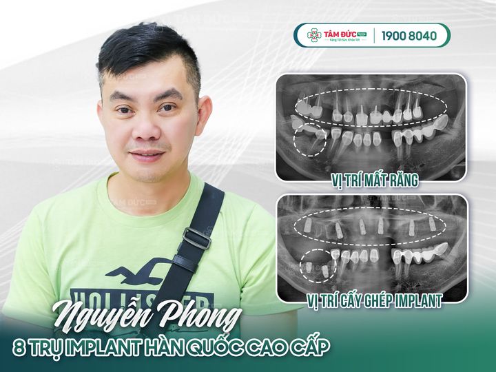 địa chỉ trồng implant uy tín tại đà nẵng