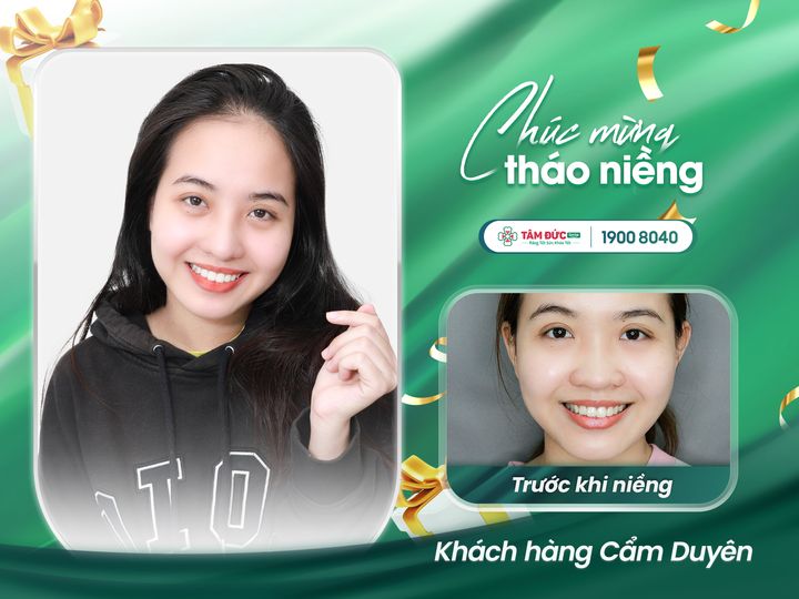 địa chỉ niềng răng đẹp tại đà nẵng