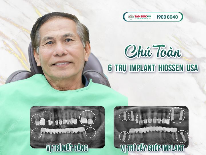 địa chỉ trồng răng implant tại đà nẵng