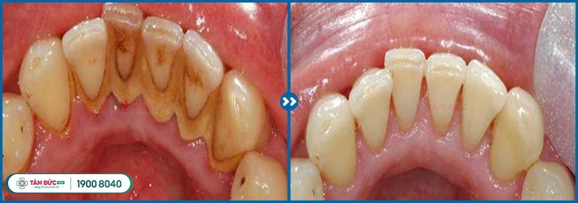 chi phí cạo vôi răng tại nha khoa Tâm Đức Smile