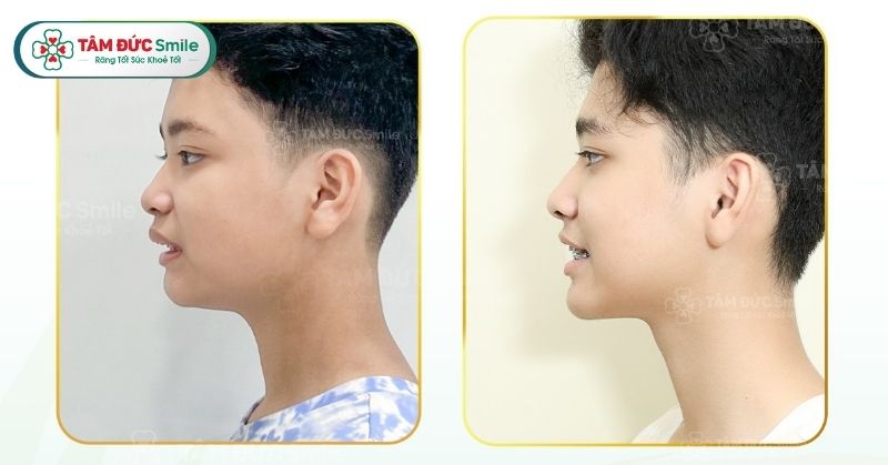 Chi phí niềng răng hô bao nhiêu? Bảng giá mới nhất tại Nha khoa Tâm Đức Smile