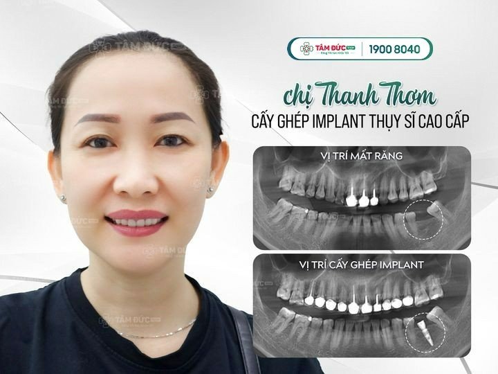 Chị Thơm sau khi cắm Implant tại nha khoa Tâm Đức Smile