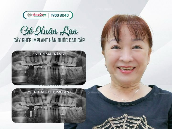 còn chân răng có bị tiêu xương hàm không