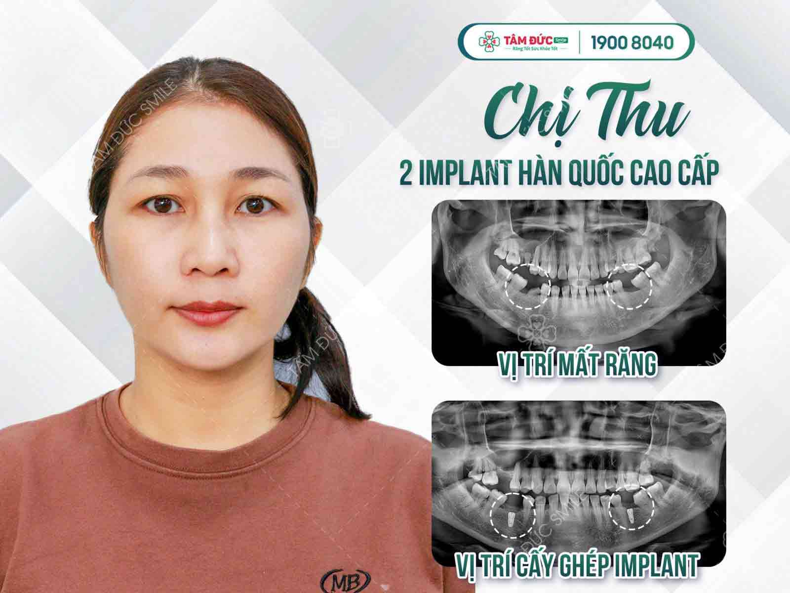 Chị Thu sau khi cắm Implant tại nha khoa Tâm Đức Smile