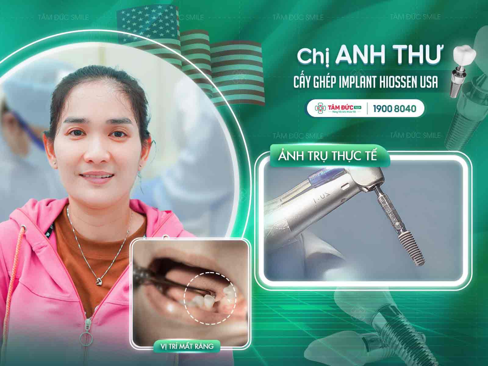 Chị Thư sau khi cấy ghép răng Implant tại nha khoa Tâm Đức Smile