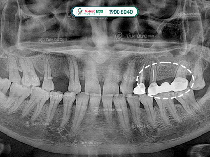 hình cầu răng sứ qua phim chụp x-quang