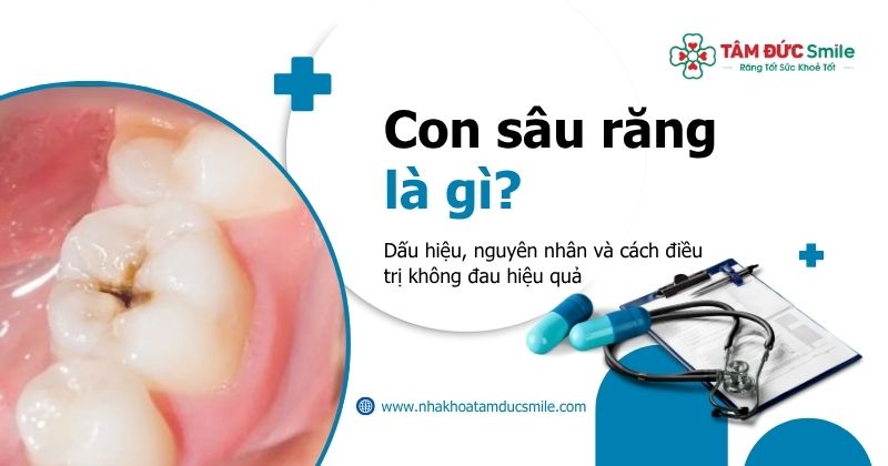 Con sâu răng là gì? Dấu hiệu, nguyên nhân và cách điều trị không đau hiệu quả