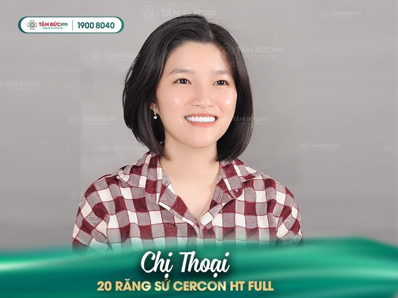 dáng răng sứ của chị Thoại