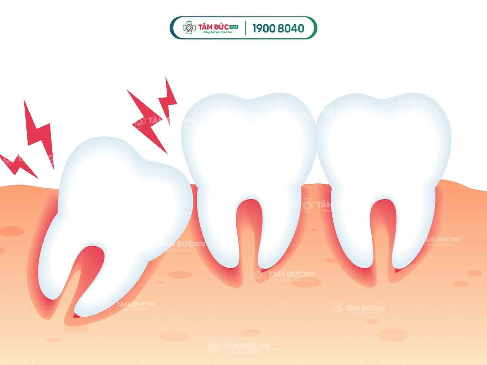 sốt nhẹ là dấu hiệu mọc răng khôn ở người lớn cần xử lý ngay