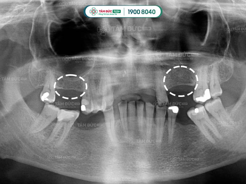 dấu hiệu tiêu xương răng qua từng giai đoạn