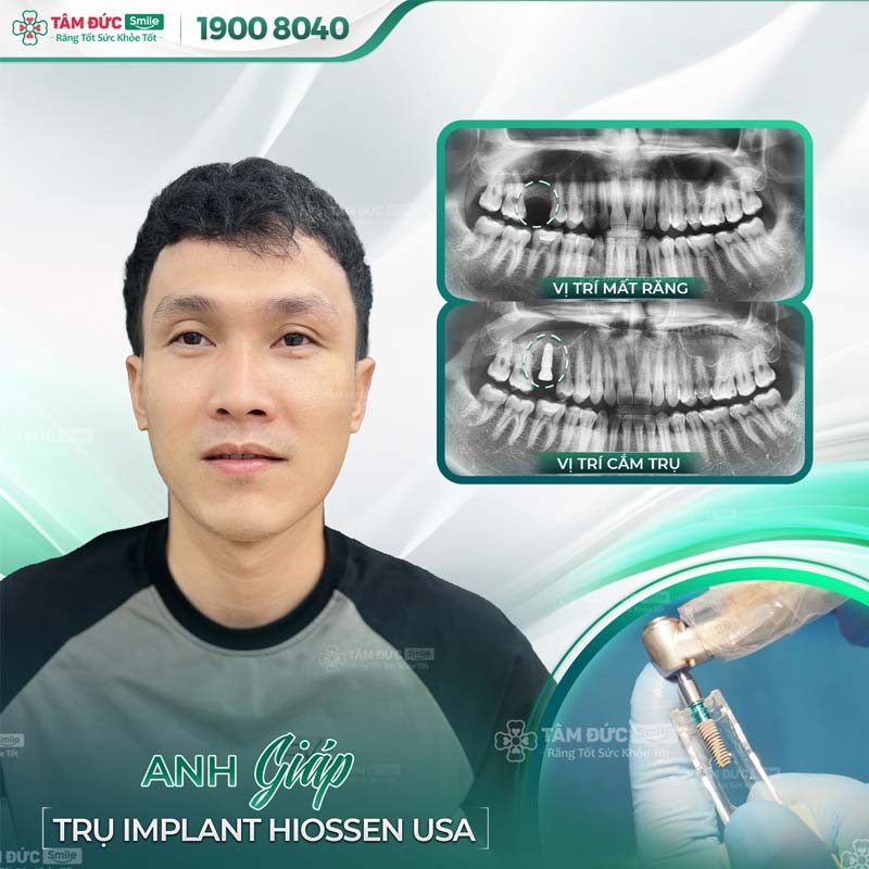 khách hàng trồng răng Implant khi thấy dấu hiệu tiêu xương răng