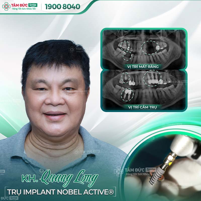 khách hàng trồng răng Implant khi thấy dấu hiệu tiêu xương răng