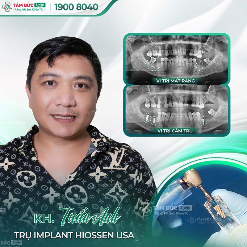 khách hàng trồng răng Implant khi thấy dấu hiệu tiêu xương răng