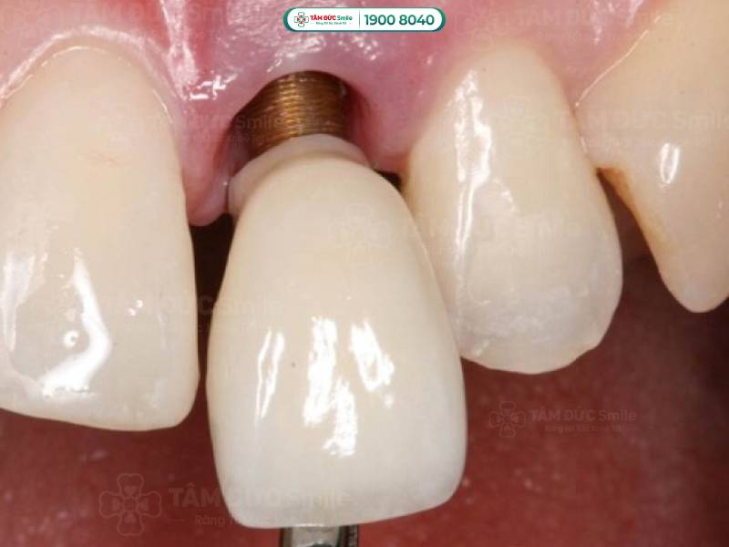 Dấu hiệu trụ Implant bị đào thải