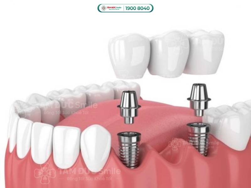 Dấu hiệu trụ Implant bị đào thải